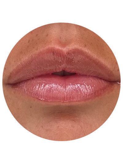 Resultado final de labios voluminosos